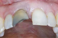 Ausgangssituation für das Setzen eines Zahnimplantates