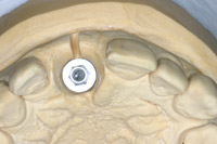 Modellanalog eines Zahnimplantates im Modell