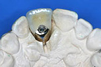 Zahnkrone auf Zahnimplantat im Modell