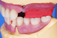 Abstimmung der Zahnprothesen im Wachs