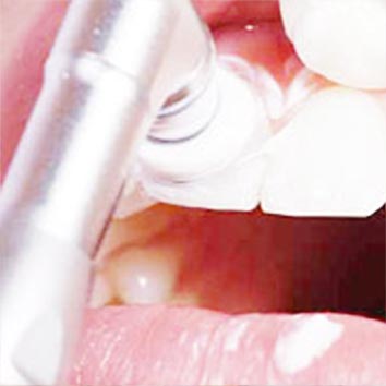 PZR – Professionelle Zahnreinigung