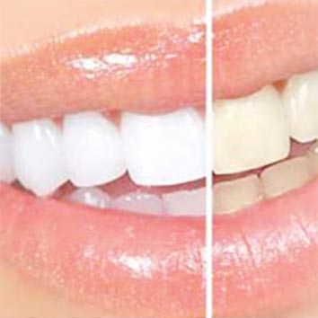 Bleaching – weiße Zähne durch Zahnaufhellung