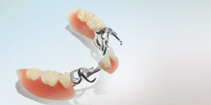 Modellgussprothese mit Metallklammern – Zahn Docs Diez