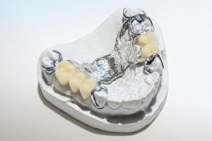 Herausnehmbare Prothese mit Transversalband auf Modell – Zahn Docs Diez