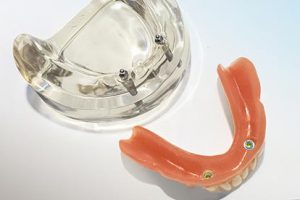 Herausnehmbare Vollprothese mit Kugelkopfankern neben Modell – Zahn Docs Diez