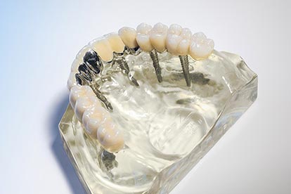 Festsitzender, implantatgetragener Zahnersatz für den zahnlosen Oberkiefer auf Modell