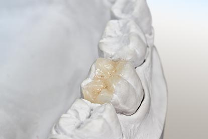Inlay auf einem Modell – Zahn Docs Diez